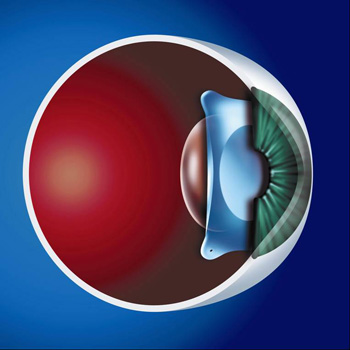 ICL Lens is positioned between the pupil and the natural eye lens