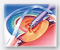 Cataract Surgery Step 1