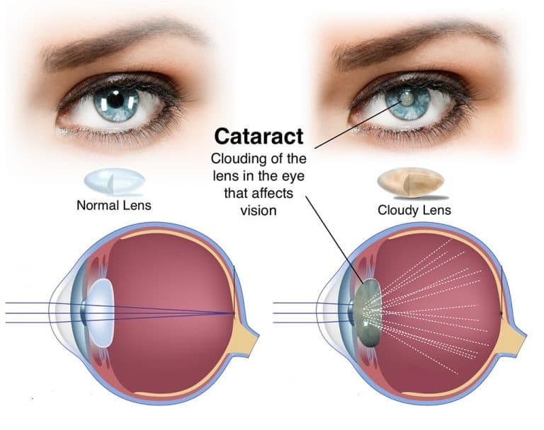 Diagram of a normal lens versus a cataract-clouded lens