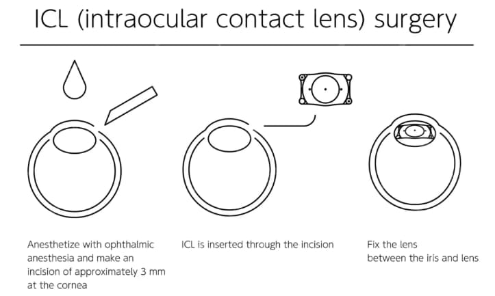 ICL (intraocular contact lens) surgery diagram