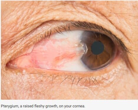 Pterygium, a raised fleshy growth, on your cornea.