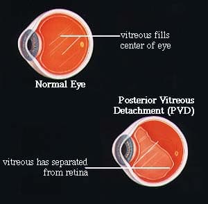 正常眼与玻璃体后脱离(PVD)对比示意图