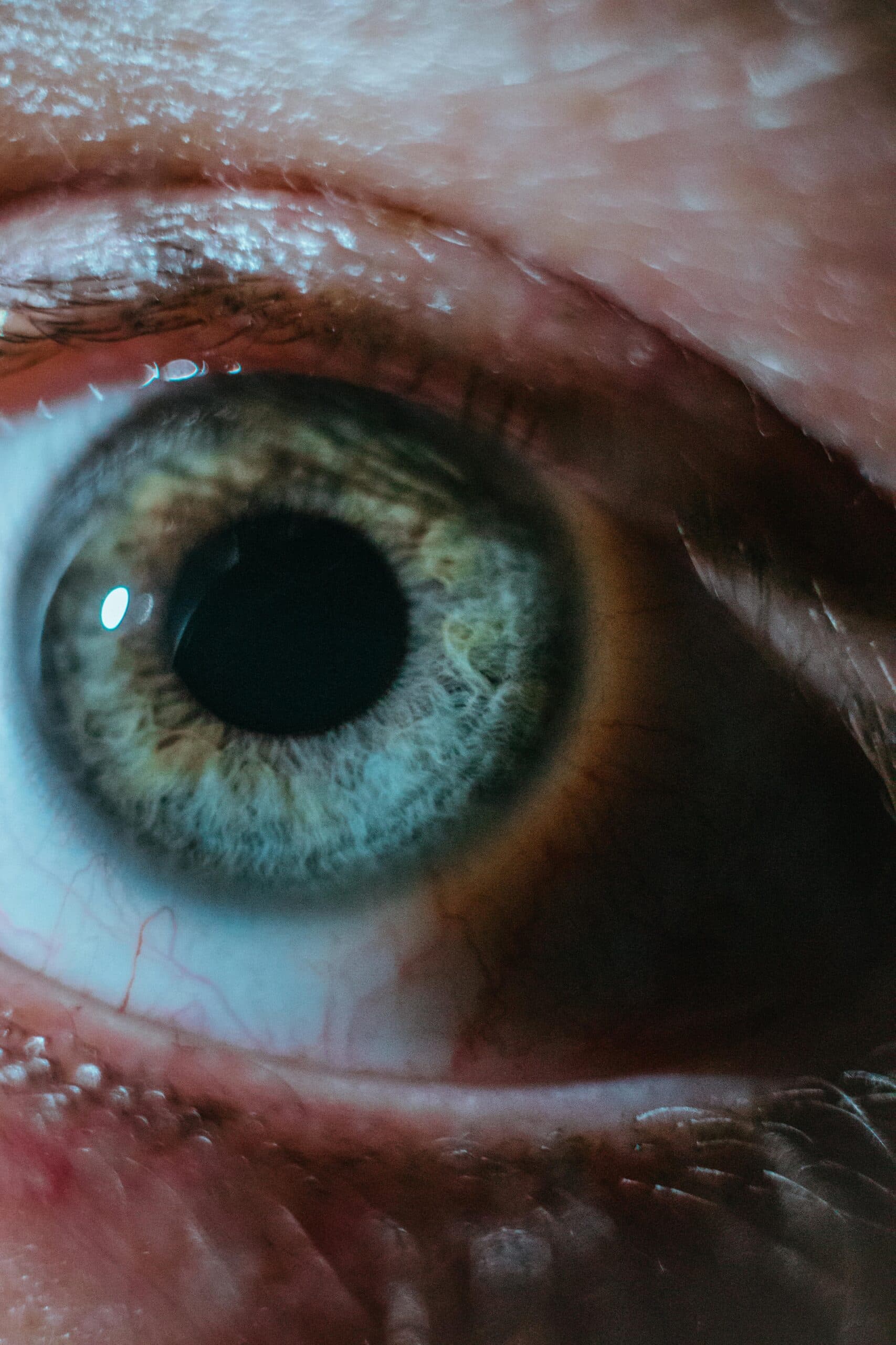 Thin Cornea